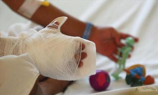 Aumentó a 50 el número de quemados por pólvora en el Valle