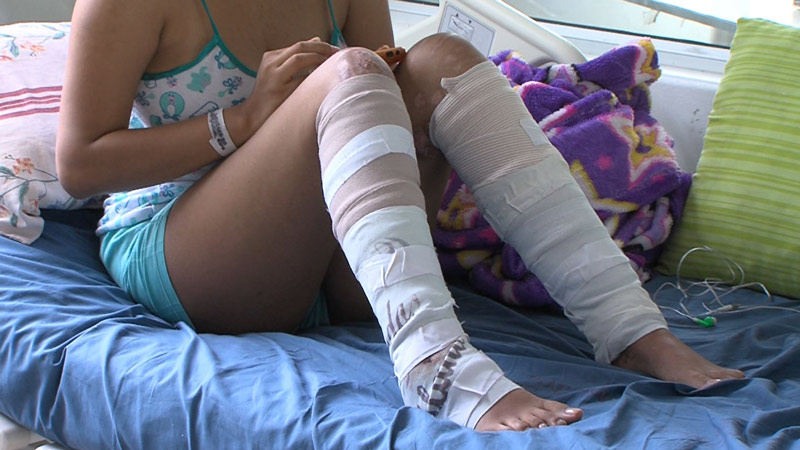 Aumentó a 23 el número de quemados con pólvora en el Valle durante diciembre