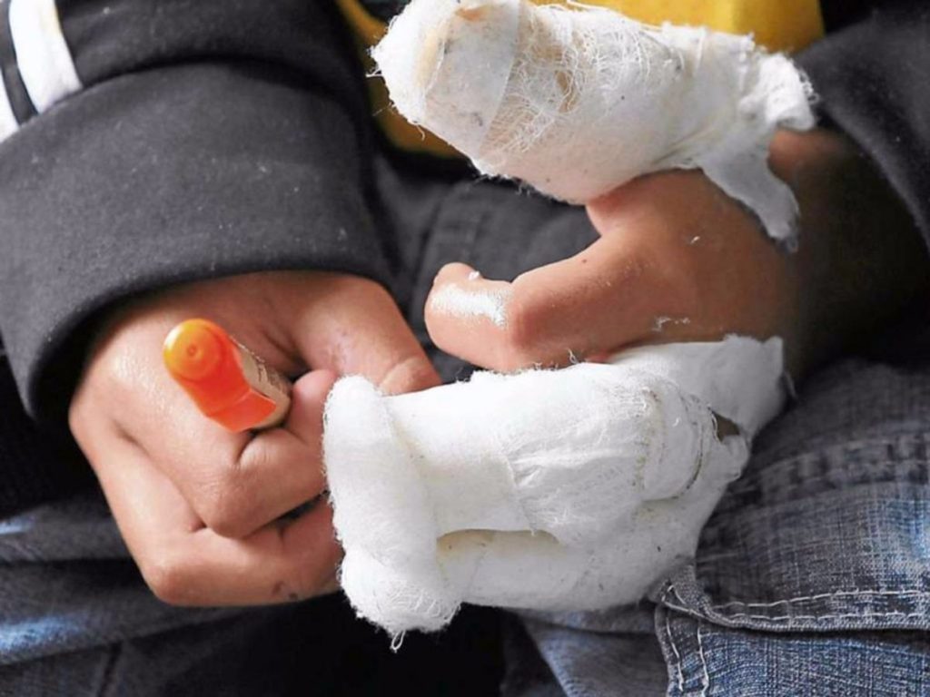 Cuatro personas quemadas por pólvora en celebración de fin de año en Cali