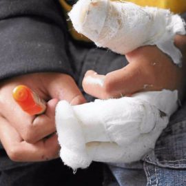 Tome nota: Esto es lo que debe y no debe hacer si sufre quemaduras con pólvora