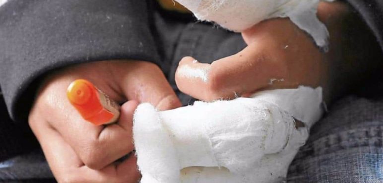 Tome nota: Esto es lo que debe y no debe hacer si sufre quemaduras con pólvora