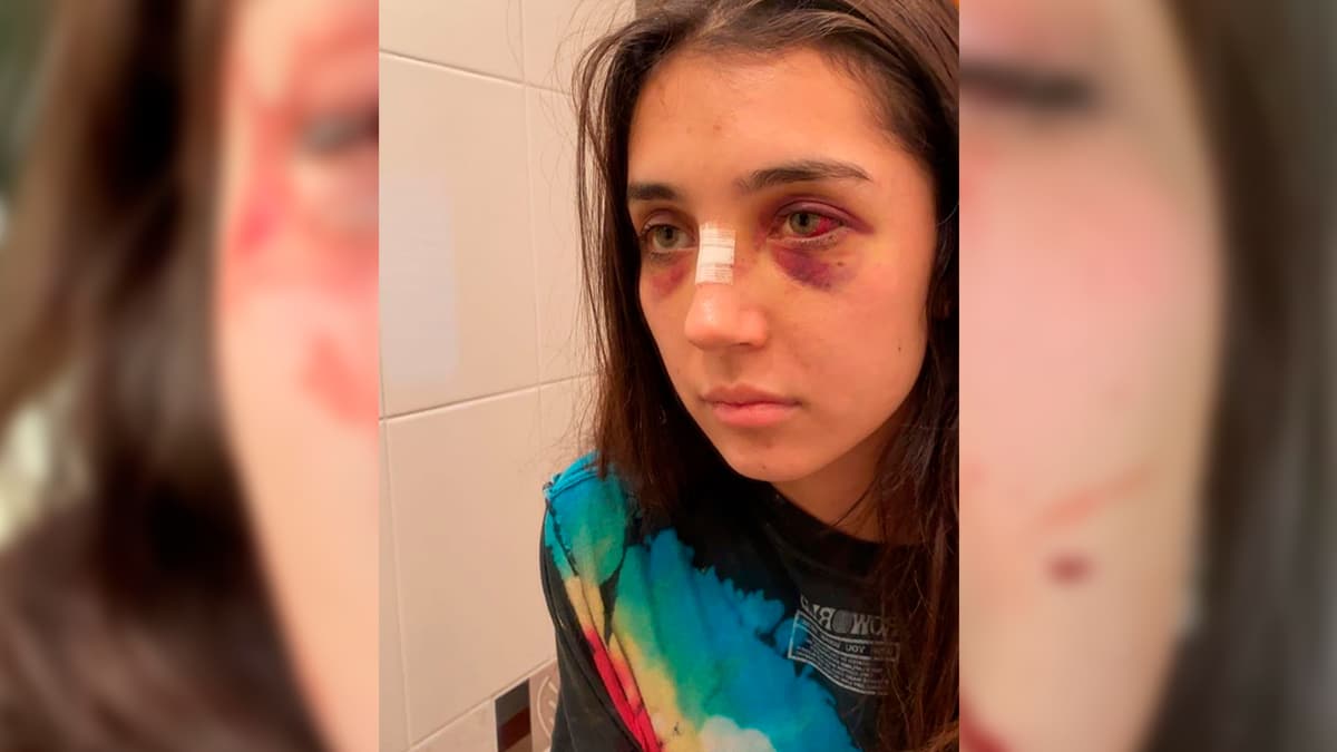 El drama que vive Laura Rincón luego de que su expareja le prendiera fuego