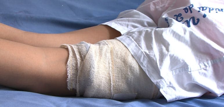 Quemaduras por pólvora: Conozca qué hacer en caso de una emergencia