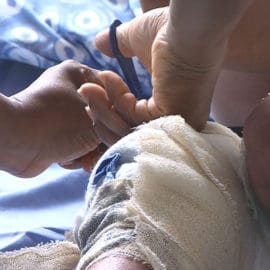 Preocupación por quemados con pólvora en el Valle: ya son 30 casos