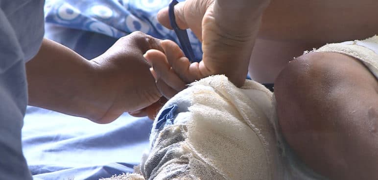 Preocupación por quemados con pólvora en el Valle: ya son 30 casos