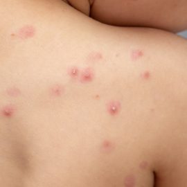 Ya son 10 los casos de la viruela del mono confirmados en Colombia por el INS