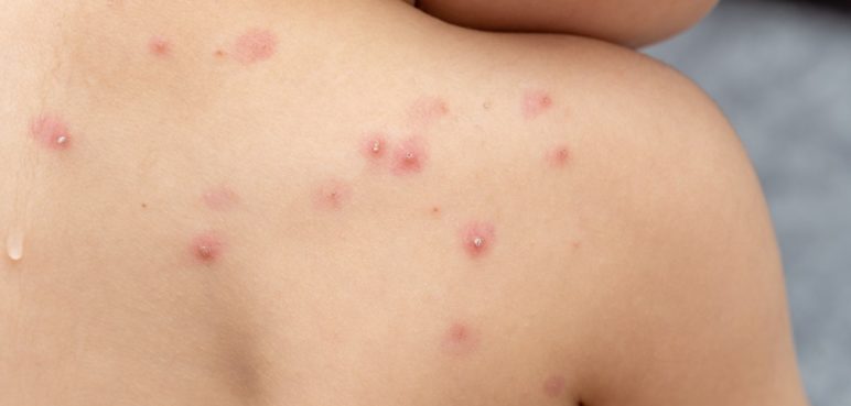 Colombia no ha registrado casos de viruela del mono: Instituto Nacional de Salud