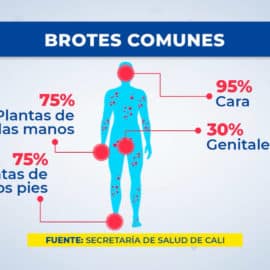 Abecé de la Viruela del Mono: todo lo que debe saber de la enfermedad