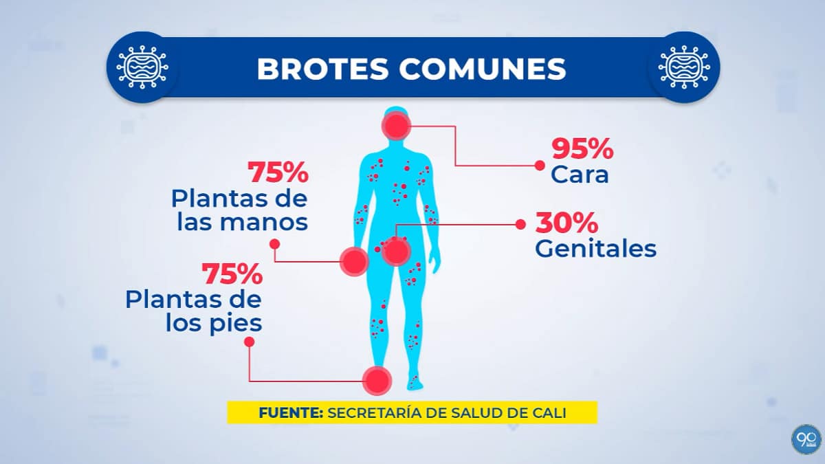 Descartan cuatro casos sospechosos de Viruela del Mono en Cali