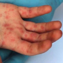 Suben casos de Viruela del Mono en Cali: Ya son 16 personas positivas