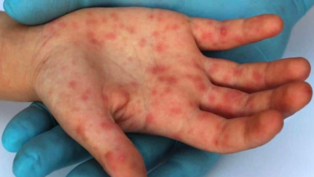 Suben casos de Viruela del Mono en Cali: Ya son 16 personas positivas