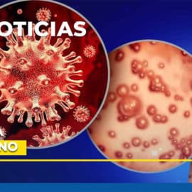 Descartan cuatro casos sospechosos de Viruela del Mono en Cali