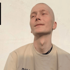 Falleció tiktoker Charlie que mostraba de manera divertida su lucha contra el cáncer