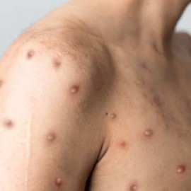 Sigue en aumento la cifra de contagios por viruela del mono en Colombia