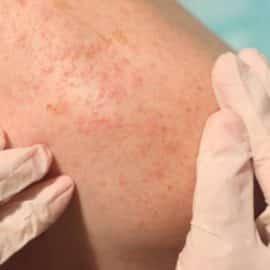 Colombia sería el país con mayor cifras de contagios por viruela del mono a nivel mundial
