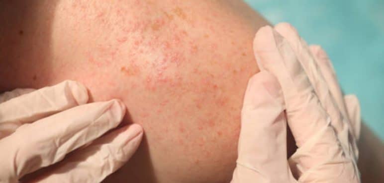 Colombia sería el país con mayor cifras de contagios por viruela del mono a nivel mundial