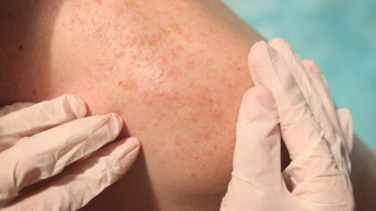 Colombia sería el país con mayor cifras de contagios por viruela del mono a nivel mundial
