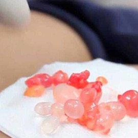 ¡Ya es delito! Sancionan ley que prohíbe el uso de biopolímeros en cirugías