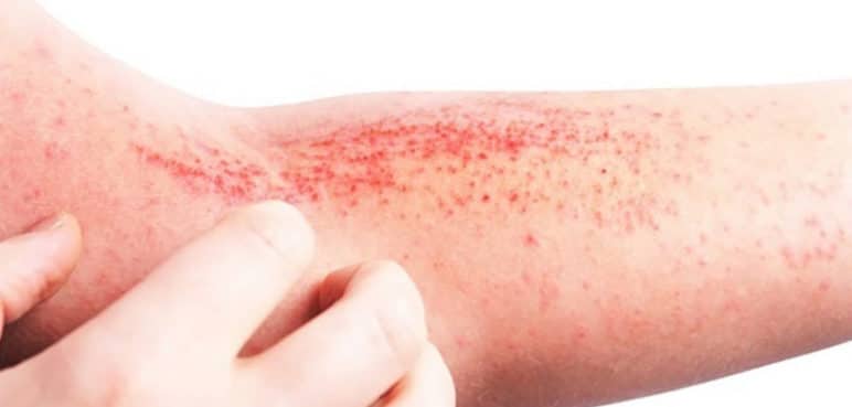 Recomendación: enfermedades de la piel no son un asunto “cosmético”