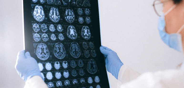 ¿Qué es el alzhéimer precoz? Conozca los síntomas de esta enfermedad poco frecuente