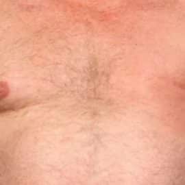 Cáncer de mama masculino: Crece alerta por diagnósticos tardíos