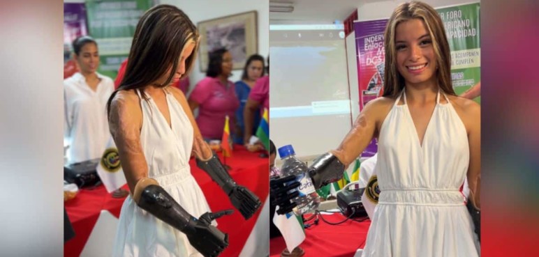 Karol Bastidas, ejemplo e inspiración: la deportista ya tiene sus prótesis robóticas